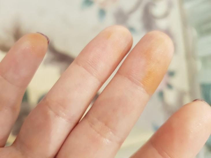 Желтые пятна на коже: причины болезней, виды и лечение