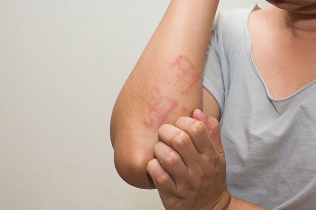 причины появления аллергического дерматита