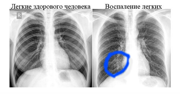 диагностика пневмонии