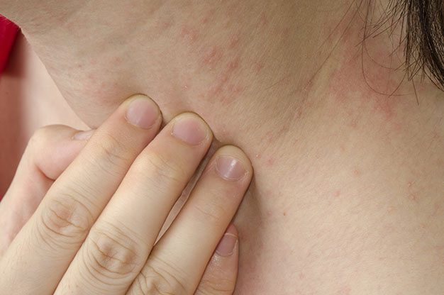 Причины возникновения аллергического дерматита